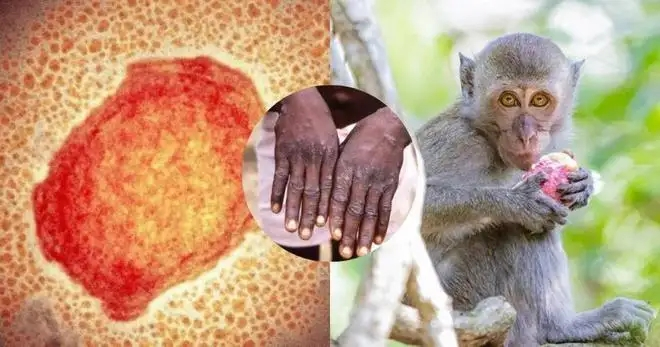 猴痘病毒，距離我們遠(yuǎn)嗎？